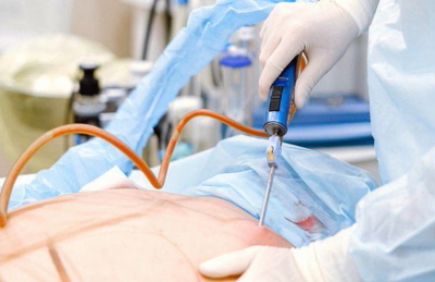 Liposuccion